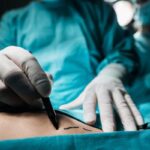 Yaz öncesi estetikte zirvede: Fazla yağlara veda zamanı! Liposuction kimlere yapılmaz? Uzmanlar uyarıyor: “Havalar çok ısınmadan yaptırılmalı”